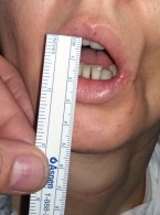 Mikrostomia po oparzeniu chemicznym jamy ustnej – opis przypadku
