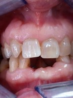 Dysplazja zębiny typu I – opis przypadku