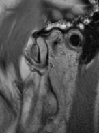 Diagnostyka obrazowa stawów skroniowo-żuchwowych z wykorzystaniem stożkowej tomografii komputerowej i obrazowania metodą rezonansu magnetycznego 