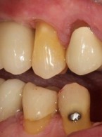 Zapobieganie przeciążeniu zgryzowemu za pomocą nowoczesnych technologii jako sposób na przedłużenie żywotności prac protetycznych opartych na implantach