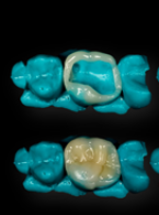 REPORTAŻ KLINICZNY. Uproszczona technika półpośrednia wykonania nakładów kompozytowych w gabinecie stomatologicznym