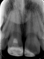 Rewaskularyzacja – postępowanie kliniczne