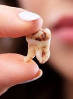 Analiza częstości występowania próchnicy korzenia u osób powyżej 65. roku życia