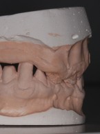 Rekonstrukcja uzębienia u pacjenta z obniżoną wysokością zwarcia. Opis przypadku