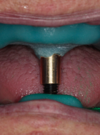 Ocena skuteczności ustalania zgryzu metodą ćwieka centralnego