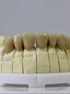 Rehabilitacja protetyczna pacjenta z zaawansowanym patologicznym starciem zębów i głębokimi ubytkami klinowymi – charakterystyka, etiologia, opis przypadku