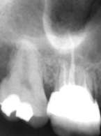 Rodzaje zdjęć wewnątrzustnych wykorzystywanych w stomatologii