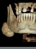 Kostniak żuchwy – opis przypadku