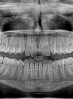 Analiza umiejętności różnicowania obrazów radiologicznych zębów przez przyszłych lekarzy dentystów – badanie pilotażowe