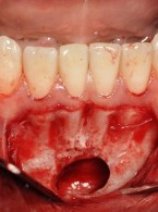 Torbiel samotna okolicy pośrodkowej trzonu żuchwy – obraz kliniczny i leczenie. Opis przypadku