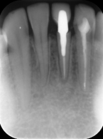 Wiarygodność badań pantomograficznych – odcinek przedni w żuchwie
