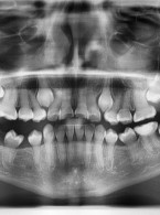 Diagnostyka obrazowa wrodzonego niedorozwoju szkliwa i wrodzonego niedorozwoju zębiny. Opis przypadków