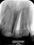 Radiologiczny obraz tkanek okołowierzchołkowych i przyzębia brzeżnego zęba po replantacji – obserwacje kilkunastomiesięczne. Opis przypadku