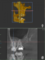 Ograniczenia zdjęć zębowych w diagnostyce okołowierzchołkowych zmian zapalnych. Opis przypadku