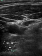 Zastosowanie ultrasonografii w monitorowaniu postępów leczenia zaburzeń czynnościowych narządu żucia