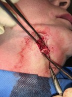 Zębopochodna przetoka zewnątrzustna okolicy podżuchwowej – opis przypadku