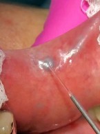 Zastosowanie lasera diodowego PRIMO® o długości fali 810 nm w leczeniu naczyniaka i włókniaka na błonie śluzowej jamy ustnej – opisy przypadków