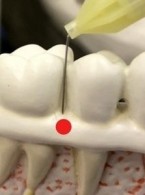 Skuteczne znieczulenie śródwięzadłowe z zastosowaniem systemów do znieczuleń komputerowych