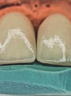 Estetyczna rehabilitacja uśmiechu z zastosowaniem licówek ceramicznych