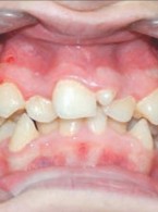 Hiperdoncja w odcinku przednim szczęki i żuchwy – przegląd piśmiennictwa i przypadków własnych