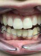 Późna replantacja dwóch zębów – opis przypadku