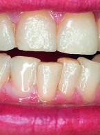 Przegląd lakierów fluorowych