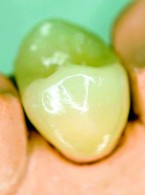 Relokacja brzegu ubytku zlokalizowanego poddziąsłowo w technice adhezyjnej – analiza problemu klinicznego