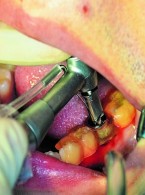 Zabieg implantacji natychmiastowej w żuchwie przeprowadzony przy użyciu nawigacji komputerowej i szablonu chirurgicznego