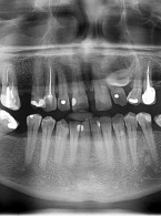 Postępowanie ortodontyczno‑implantologiczne w trudnym przypadku zatrzymania kła w szczęce