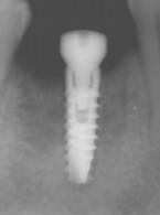 Wprowadzenie wszczepu śródkostnego w odcinku bocznym żuchwy z użyciem szablonu implantologicznego 