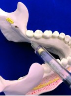 Nowe możliwości znieczuleń  podniebiennych i przewodowych  żuchwy dzięki systemom do komputerowego podawania znieczuleń (CCLAD)