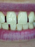 Diastemy i tremy – doświadczenia własne