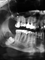 Leczenie chirurgiczne  torbieli zawiązkowej żuchwy związanej z zębem 48 – opis przypadku