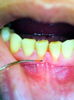 Techniki cięcia tkanek miękkich za pomocą lasera diodowego w stomatologii