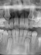 Zębiak złożony żuchwy przyczyną zatrzymania pierwszego zęba trzonowego stałego u dziewięciolatka – opis przypadku