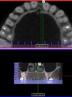 Wykorzystanie tomografii wolumetrycznej podczas ponownego leczenia kanałowego drugiego zęba przedtrzonowego szczęki