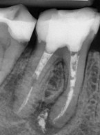 Laser diodowy o długości fali 810 nm w leczeniu endodontycznym