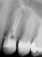 Zamknięcie rozległej perforacji z użyciem bioaktywnego materiału odtwórczego Activa – opis przypadku