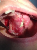 Włókniak kostniwno-kostniejący – opis przypadku