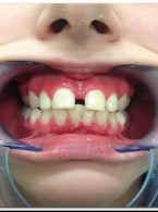 Diastema – rutynowe leczenie czy wielkie wyzwanie ortodontyczne? Opis przypadku