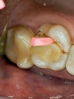 Adhezyjne uzupełnienia pośrednie w złamanych zębach bocznych – analiza problemu klinicznego