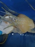 Kompozytowy most adhezyjny jako rozwiązanie alternatywne w przypadku braku możliwości leczenia kompleksowego