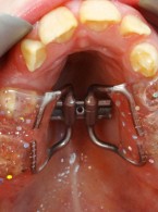 Leczenie ortodontyczne pacjentki z zespołem Marfana – opis przypadku