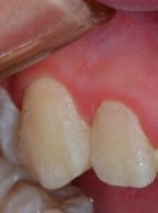 Wielospecjalistyczne leczenie estetyczne skośnego koronowo-korzeniowego złamania zęba siecznego przyśrodkowego – opis przypadku