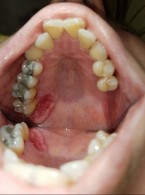 Czynnościowe kształtowanie pola protetycznego po częściowej resekcji szczęki zaopatrzonej przeszczepem tkankowym – opis przypadku