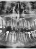 Interdyscyplinarne leczenie stomatologiczne pacjenta po radioterapii w obrębie głowy i szyi – opis przypadku