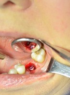 Implantacja natychmiastowa u pacjentki leczonej z powodu osteoporozy lekami z grupy bisfosfonianów