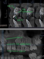 Zespołowe leczenie zatrzymania górnego zęba siecznego przyśrodkowego spowodowanego przez ząb nadliczbowy – opis przypadku