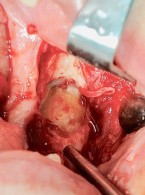 Cementoblastoma – rzadki guz zębopochodny. Opis przypadku