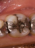 Badanie uwalniania rtęci z amalgamatów dentystycznych do roztworu sztucznej śliny – wstępne doniesienia